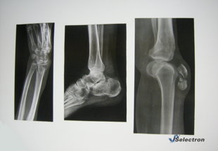 Broken Bone X-ray Films (item #34)