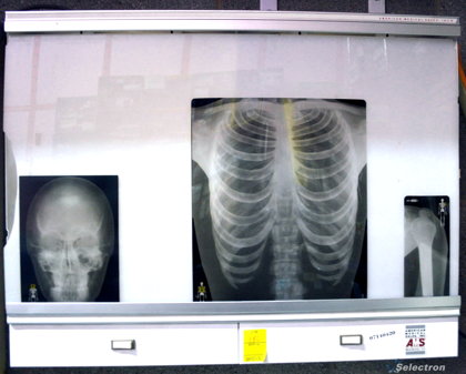 Radiography Screens 